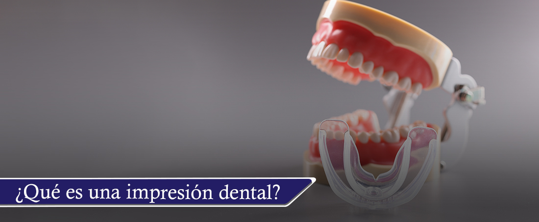 ¿Qué es una impresión dental y para qué sirve?